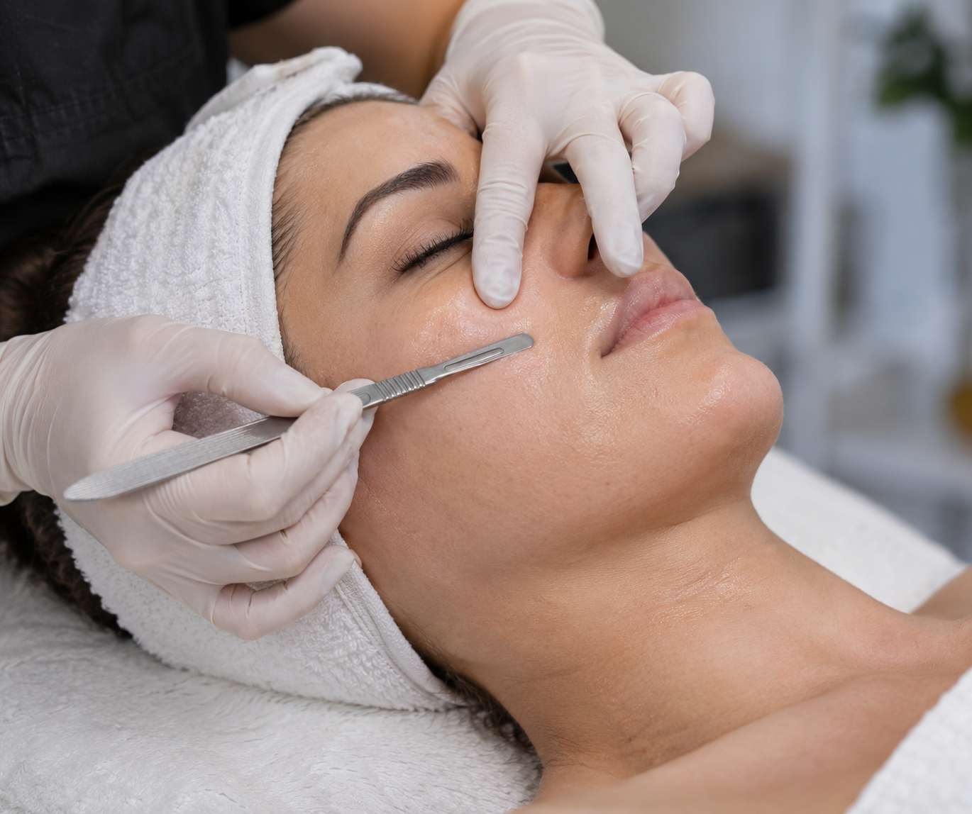 Microneedling treatment